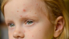 child with lesions
