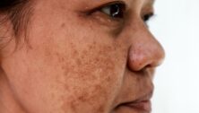 woman with discolored patches on her cheek