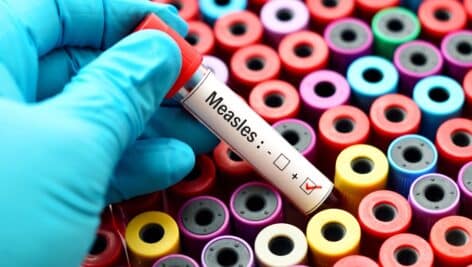 Measles blood test.